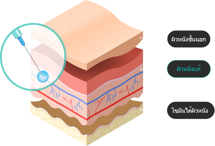 รีจูรัน ฮีลเลอร์ ที่ต้องใช้ ทักษะในการ ฉีด อย่าง ละเอียดและแม่นยำเข้าสู่ชั้นหนังแท้